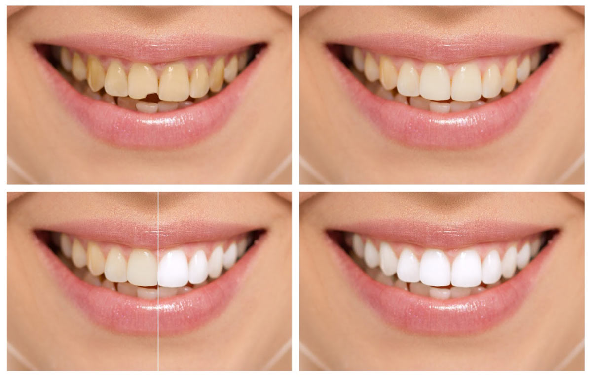 Cosmetic Dental Bonding | Sharon Dental