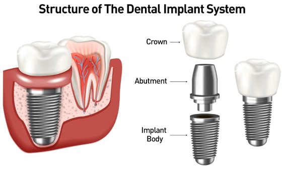 https://sharondental.ca/wp-content/uploads/2024/08/dental-implant-system.jpg