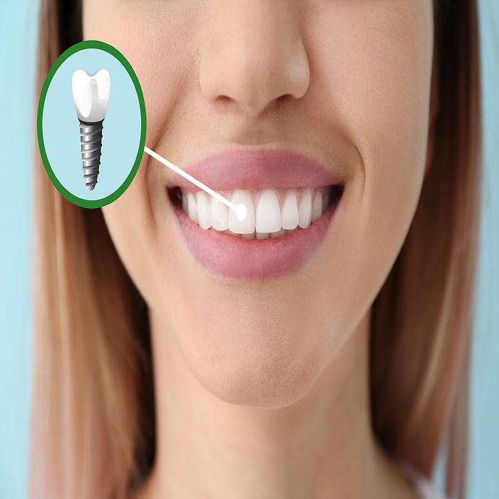 Dental Implant dentist in East Gwillimbury | Sharon Dental