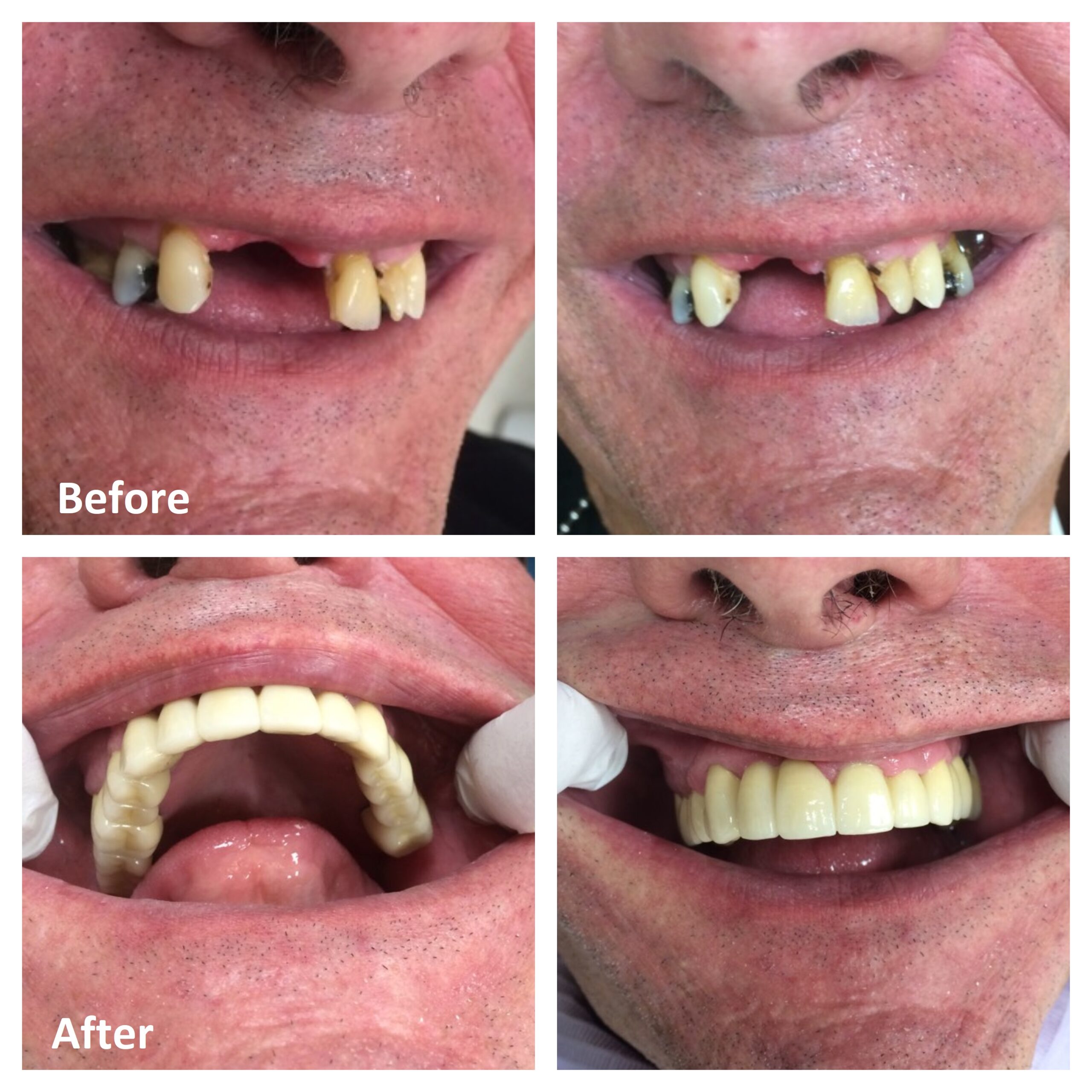 Smile Makeover - cosmetic Dentist -Sharon Dental